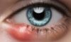 Eye Styes: Causes and Effective Home Remedies Uncovered
